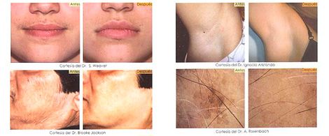 Clínica Dermatológica Santiago Aparicio Fernández arrugas antes y después